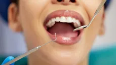 Desde $25: Limpieza Dental y Blanqueamiento